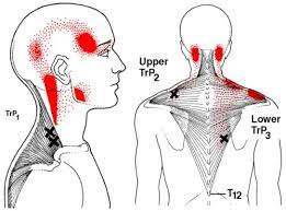 Headache Treatment In Rugby