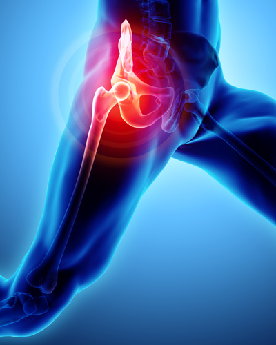 Hip pain & "bursitis"... what is going on & what you can do about it