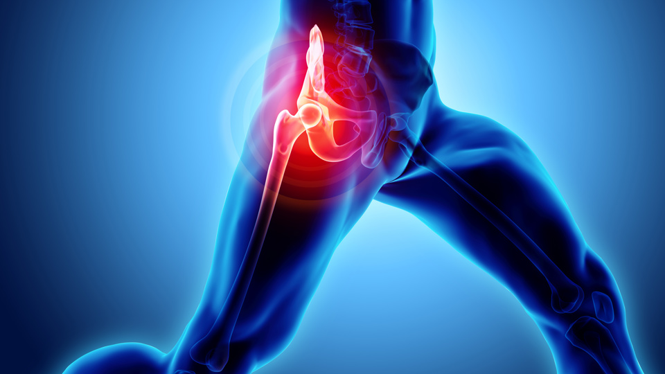 Hip pain & "bursitis"... what is going on & what you can do about it
